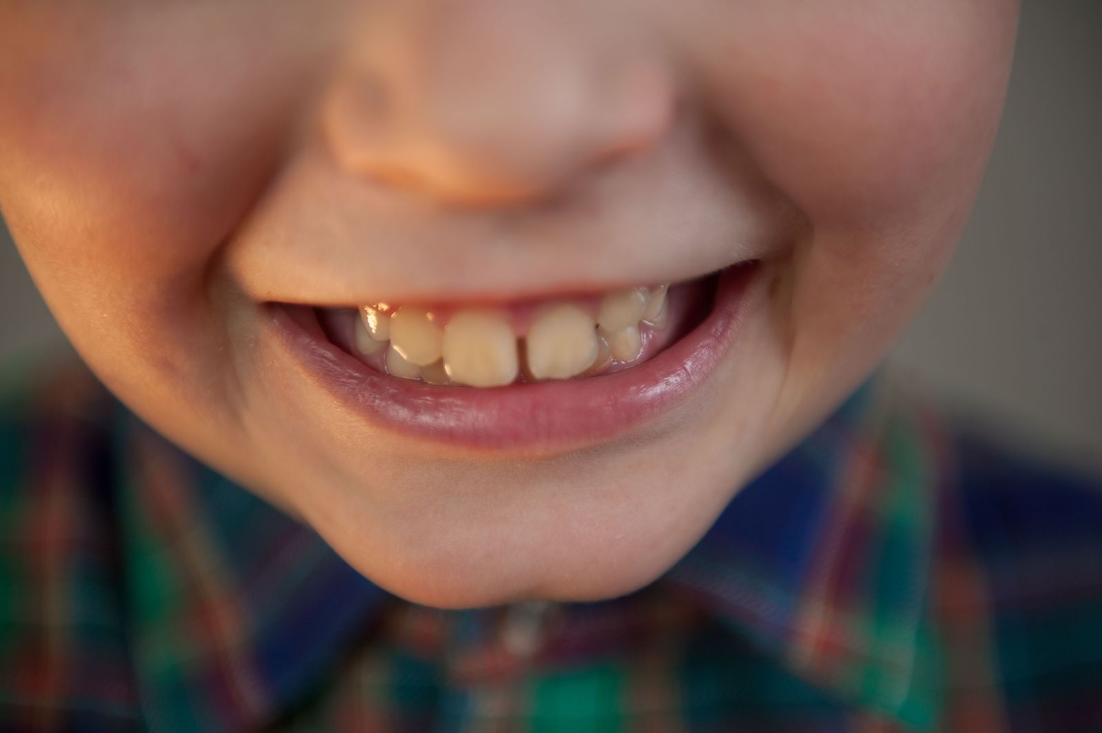 What's That Spot? A Parent's Guide to Discoloration on Kids' Teeth